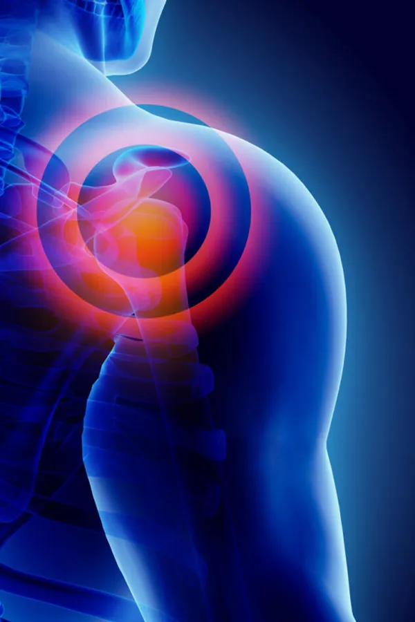 A 3D illustration of a shoulder joint highlighted with pain. Get treatment for bursitis from ProCare Wellness Institute in Virginia Beach.