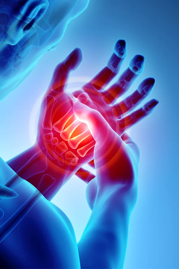 3D illustration of a hand with carpal tunnel syndrome. Get treatment for carpal tunnel syndrome from ProCare Wellness Institute in Virginia Beach.