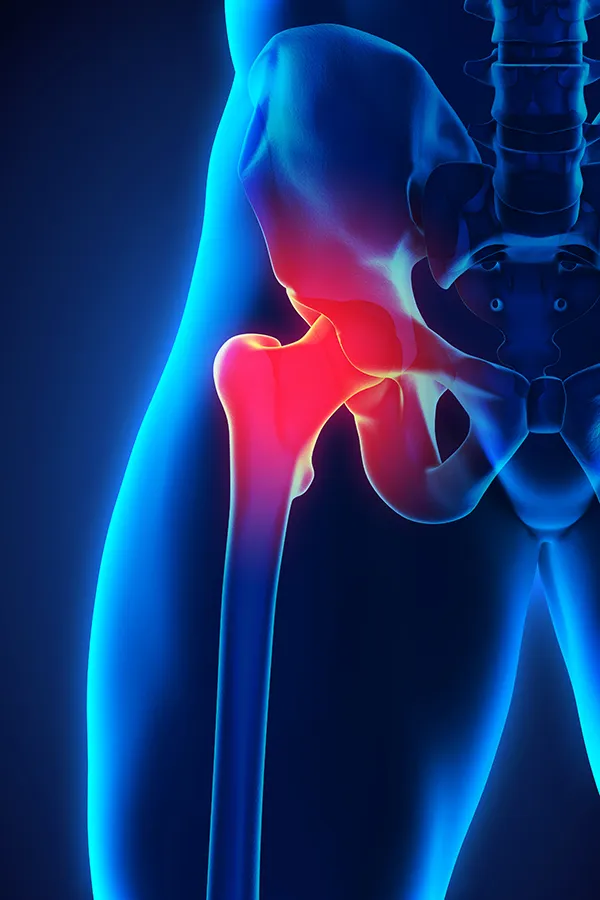 3D illustration of the human hip joint. Get treatment for larum tears from ProCare Wellness Institute in Virginia Beach.
