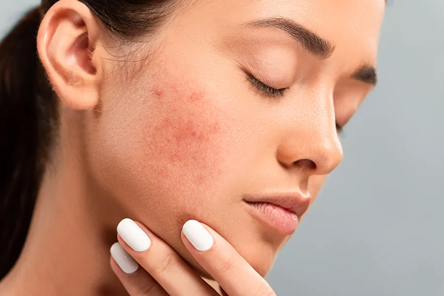 Radiofrequency-Microneedling-for-Acne-Clinic A woman with acne. Schedule Radiofrequency Microneedling for Acne Scars Treatment from ProCare Wellness Institute in Virginia Beach.