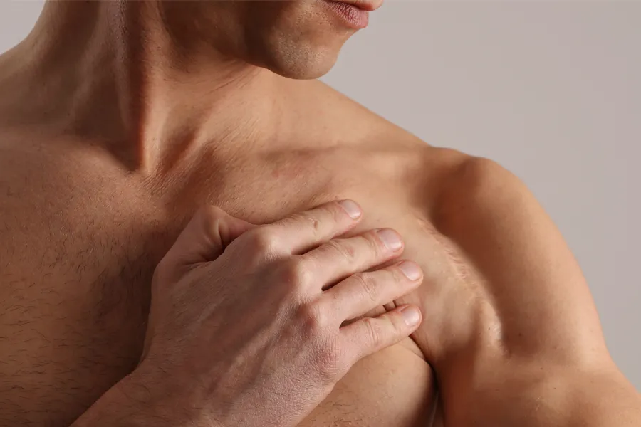 A scar running across a man's shoulder. Schedule Radiofrequency Microneedling for Scars Treatment from ProCare Wellness Institute in Virginia Beach.