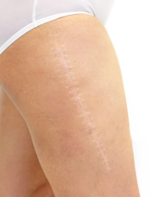 A scar running down a woman's leg. Get Radiofrequency Microneedling for Scars Treatment from ProCare Wellness Institute in Virginia Beach.