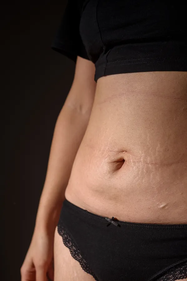 Radiofrequency-Microneedling-for-Stretch-Marks-Treatment A woman with stretch marks on her belly. Get Radiofrequency Microneedling for Stretch Marks Treatment from ProCare Wellness Institute in Virginia Beach.